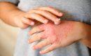 Expert Advice on Eczema