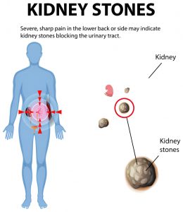 kidney stones causing severe pain